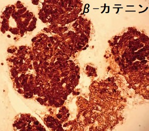 篩(ふるい)型[モルラ(渦巻き)型]甲状腺乳頭癌　β-カテニン染色